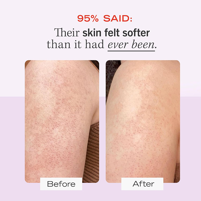 Beauty Skin 10% AHA with Glycolic and Lactic acids, Helps Reduce Chicken Skin Bumps, Body Scrub(pic4)
